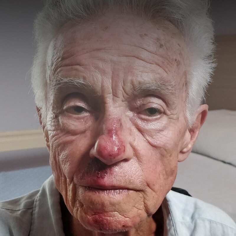 Actor Massimo Mirani as Vittorio with prosthetic makeup bruising on set — Discesa Libera Italian feature film, 2024